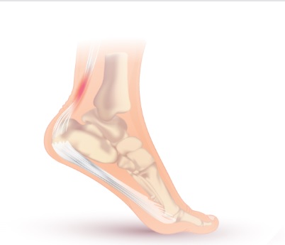 Achilles Tendonitis